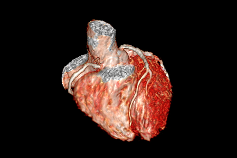 心臓の3次元MRI画像