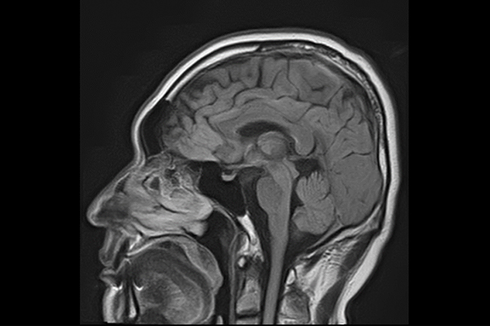 脳の断面MRI画像