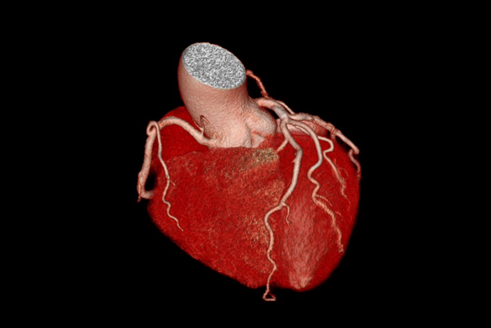 心臓3次元画像（造影ありCT））