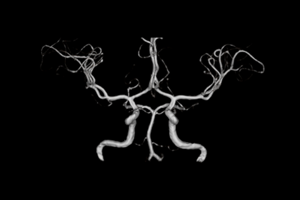脳動脈3次元画像