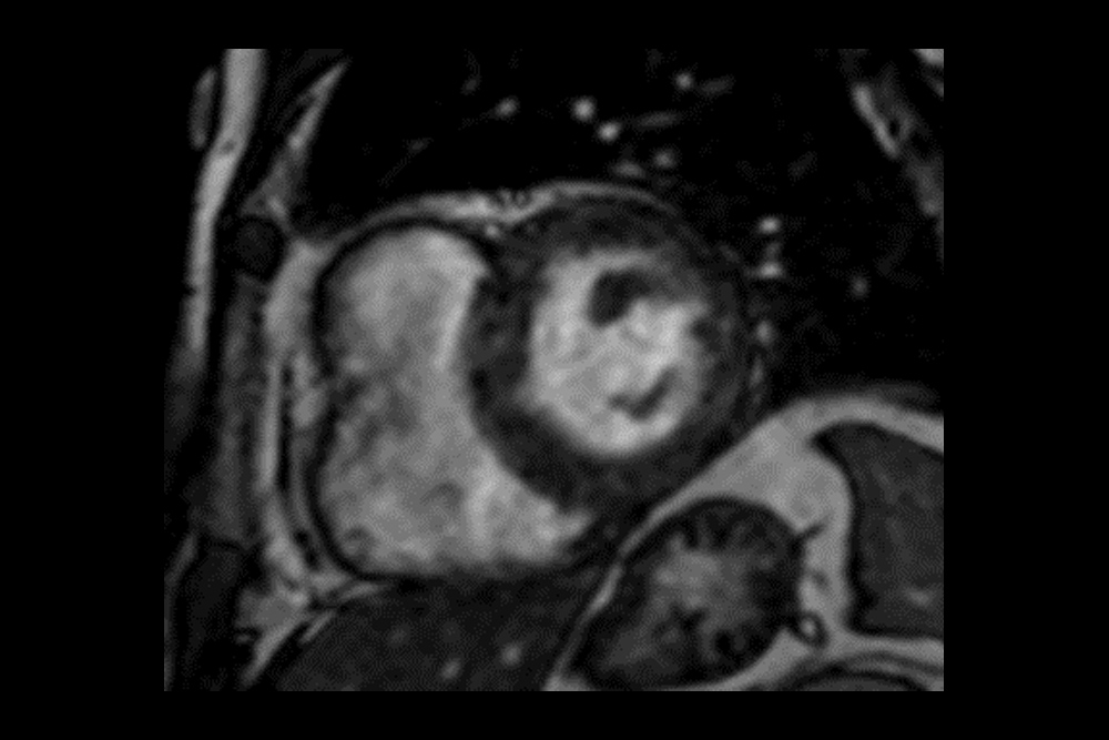 心臓断面像（造影なしMRI）